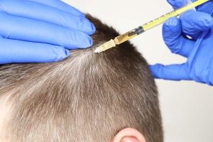 مزوتراپی مو چیست و چه تاثیری در دمان ریزش مو دارد؟